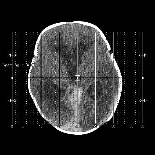 White cerebellum sign (reversal sign)