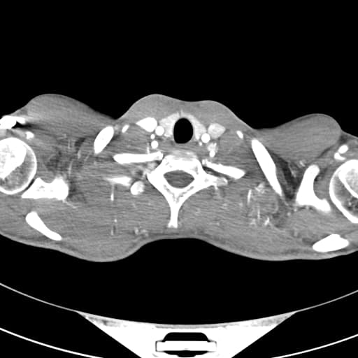 Surgically corrected transposition of the great arteries