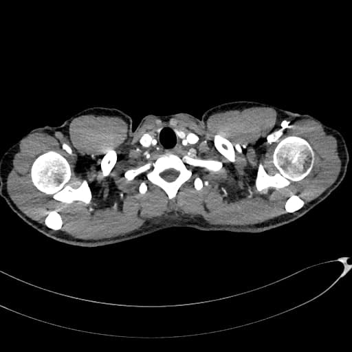 Calcified lung metastasis - osteosarcoma (Di căn phổi vôi hóa – u sụn xương)