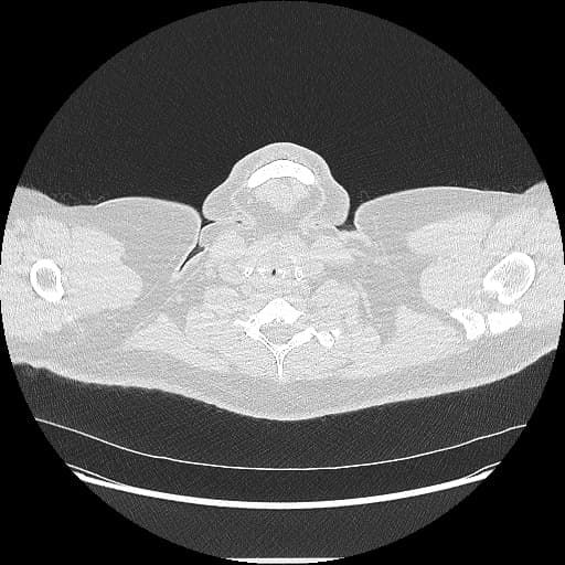 Right Pulmonary Agenesis (Không phát triển phổi)