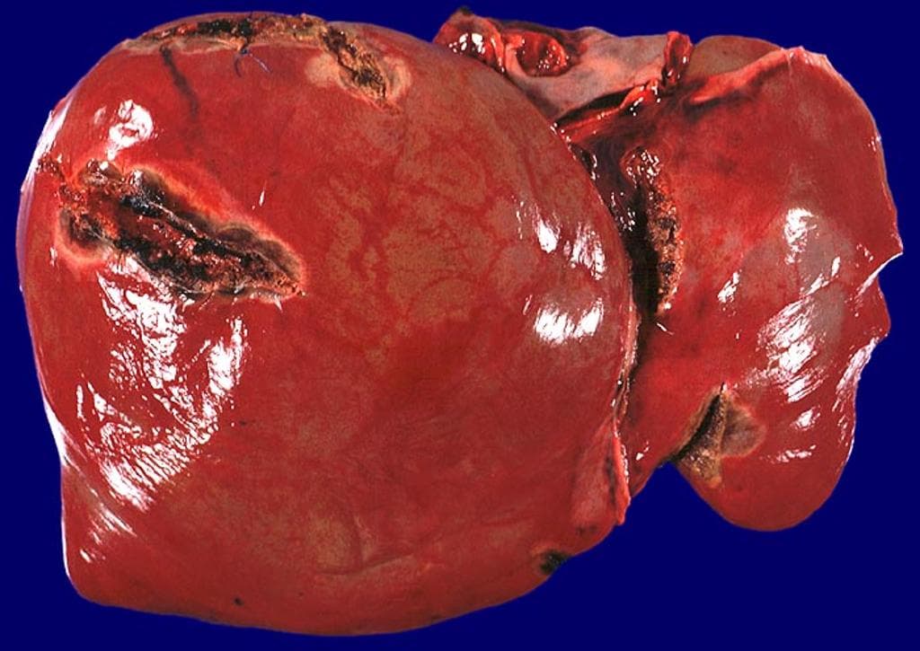 Traumatic Liver Laceration (Gross Pathology) (Vết rách gan do chấn thương (giải phẫu bệnh đại thể))