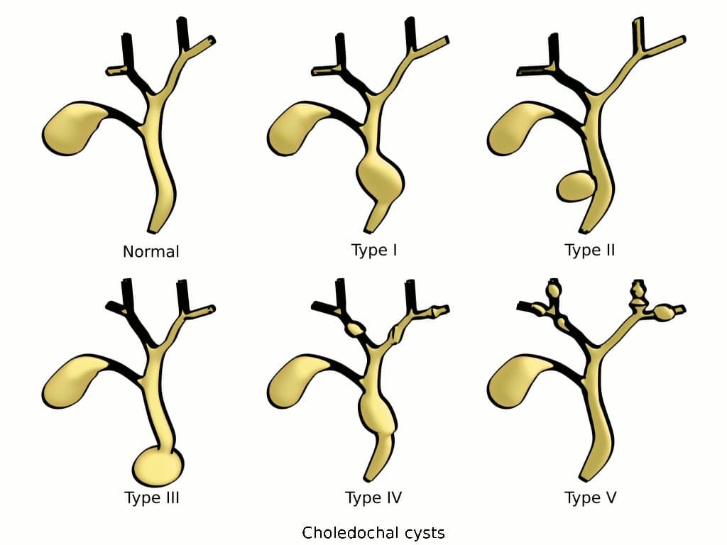 Choledochal Cyst Types (Todani Classification) (Các loại nang ống mật chủ (sơ đồ))