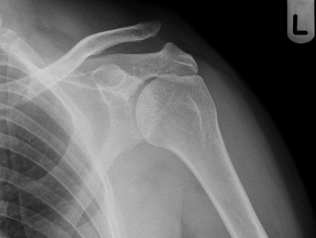 Acromioclavicular Joint Injury - Type III (Chấn thương khớp cùng đòn - loại III)