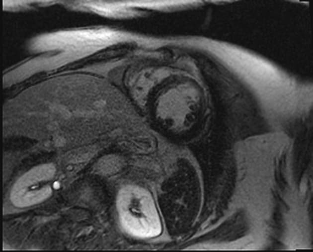 Takotsubo cardiomyopathy - atypical location
