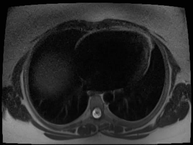 Hepatic adenoma - lipid-poor