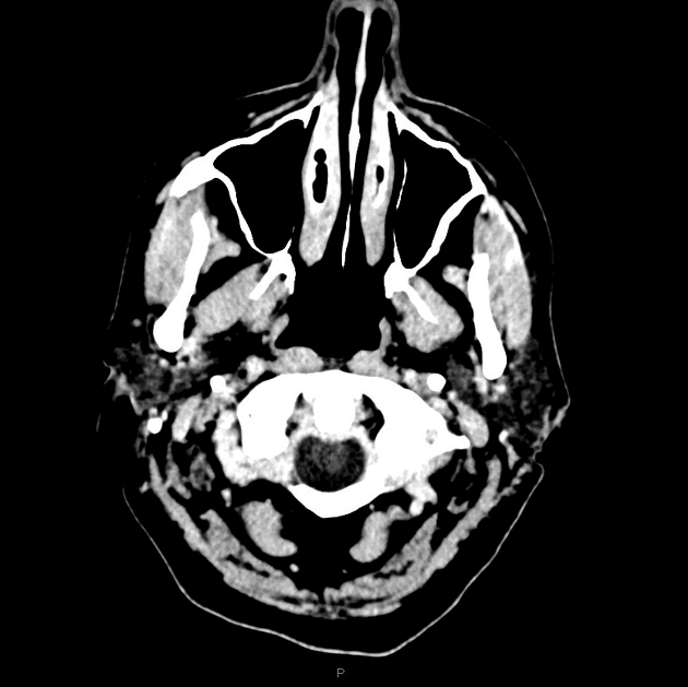 Primary CNS lymphoma (cerebellar)