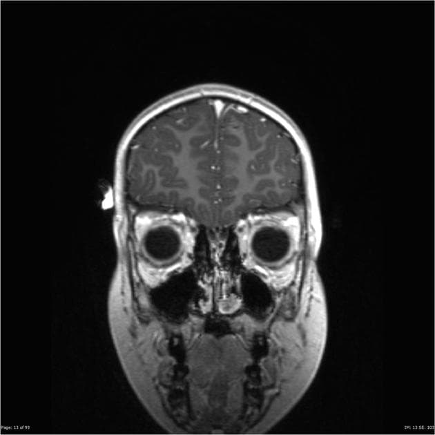 Adamantinomatous craniopharyngioma
