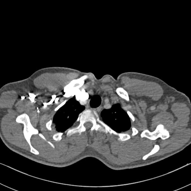 Marfan syndrome with ascending aortic aneurysm and Stanford A, DeBakey I aortic dissection