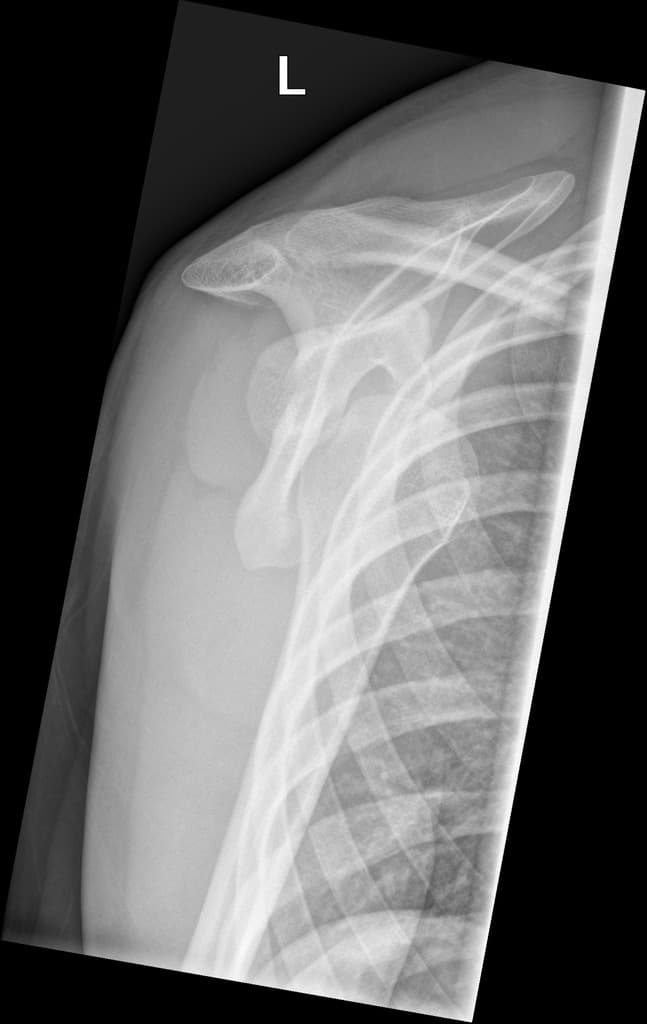 Anterior shoulder dislocation with Hill-Sachs lesion