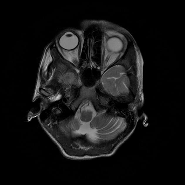Multiple Sclerosis (Xơ cứng rải rác)