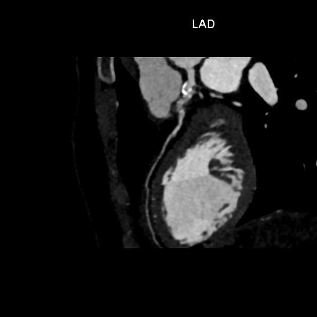 Coronary Artery Aneurysms Due to Childhood Kawasaki Disease (Phình mạch vành do bệnh Kawasaki thời thơ ấu)