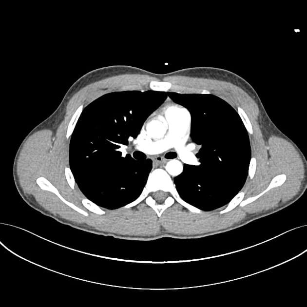 Patent ductus arteriosus