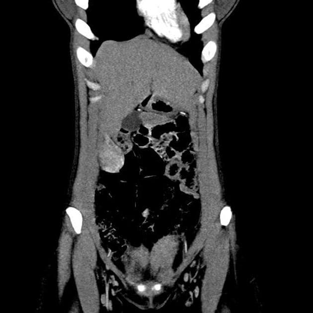 Exophytic hepatocellular adenoma