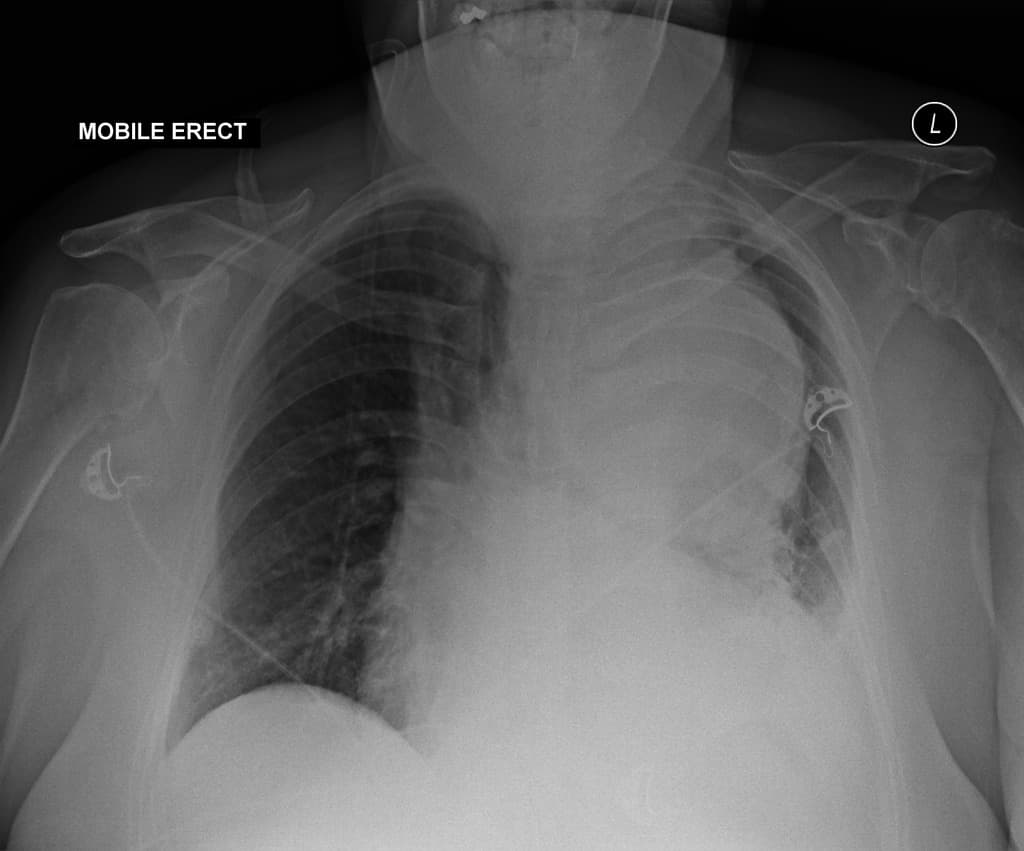 Aortic aneurysm and dissection - Stanford type A