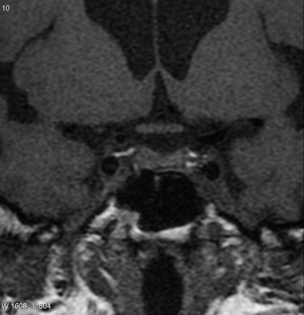 Pituitary microadenoma