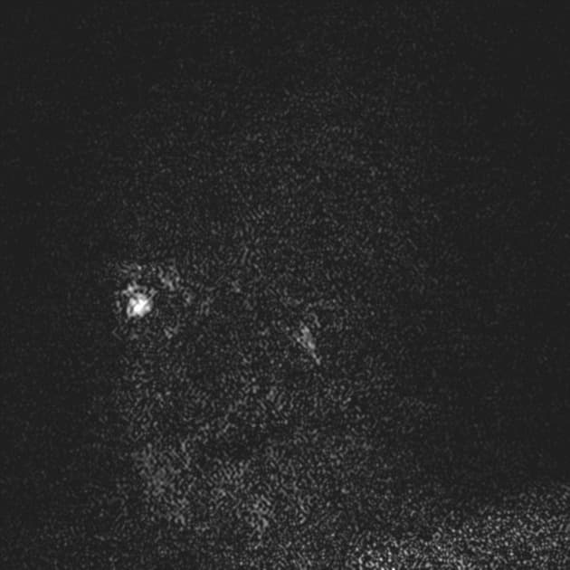 Multiple Sclerosis (Xơ cứng rải rác)