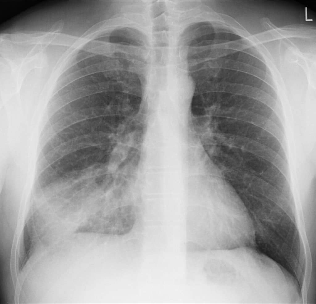 Right Middle Lobe Pneumonia (Viêm phổi – thùy giữa bên phải)