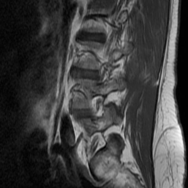 Endometriosis - deep infiltrating and involving lumbosacral spinal nerves