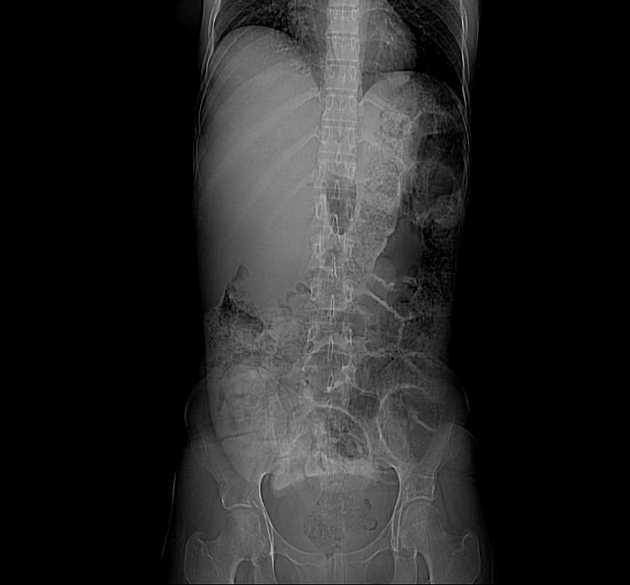 Giant Choledochal Cyst (U nang ống mật chủ khổng lồ)