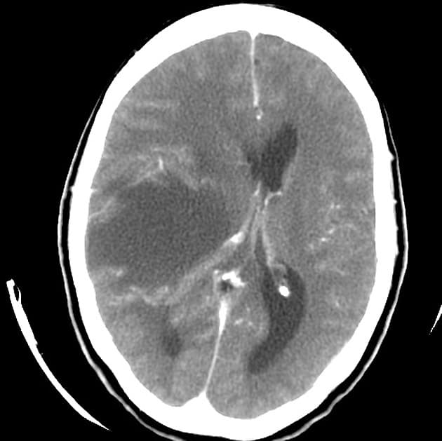 Tumefactive Demyelinating Lesion (Tổn thương mất bao myelin dạng u)