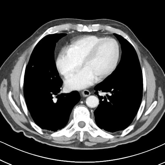 Large bowel watershed ischemia