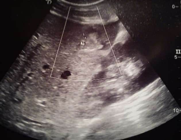 Hepatic Laceration Due to Penetrating Abdominal Trauma (Vết rách gan do chấn thương xuyên thủng)