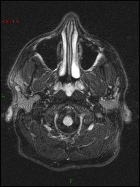 Multiple Sclerosis (Xơ cứng rải rác)