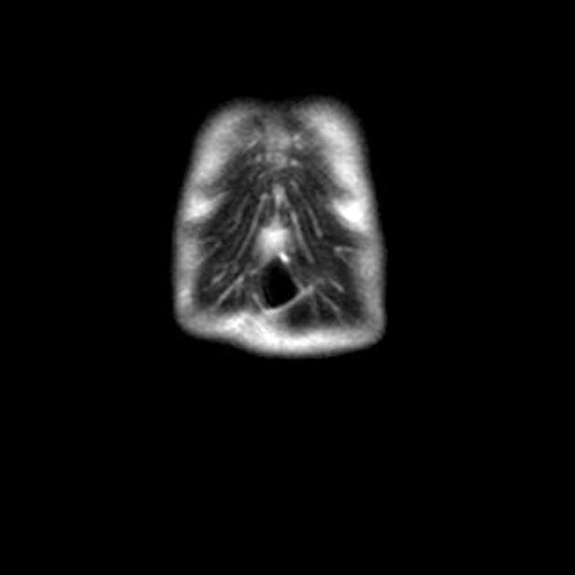 Choledochal Cyst - Type I (Nang ống mật chủ - type I)