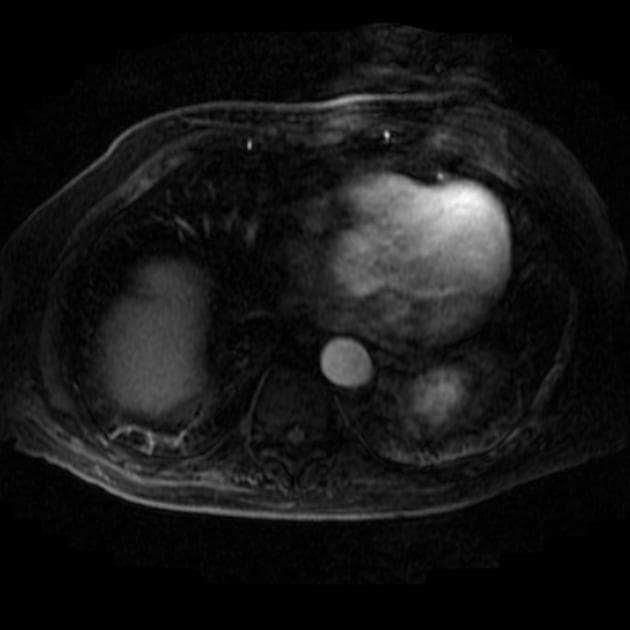 Cholangiocarcinoma - Mass-Forming Pattern (Ung thư tế bào gan dạng khối – dạng hình thành khối)