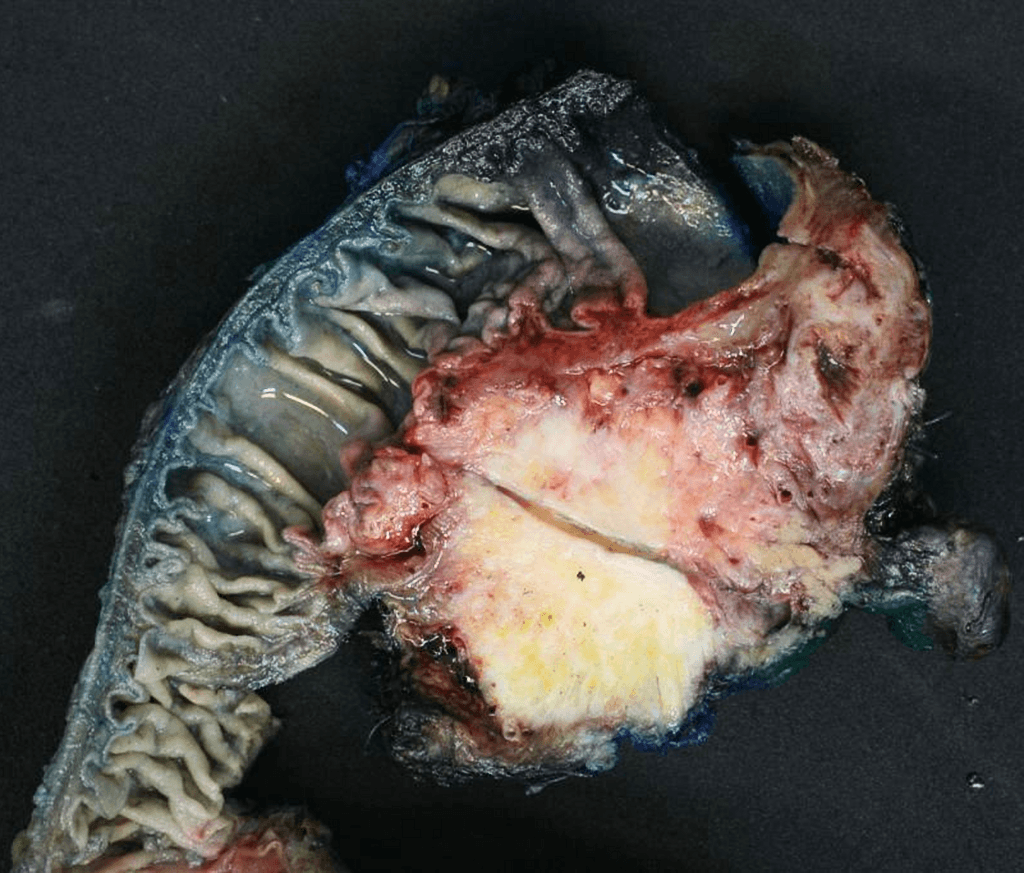 Pancreatic Carcinoma (Gross Pathology) (Ung thư tụy (giải phẫu bệnh đại thể))