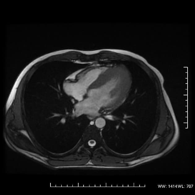 Apical non-obstructive hypertrophic cardiomyopathy (Yamaguchi hypertrophy)