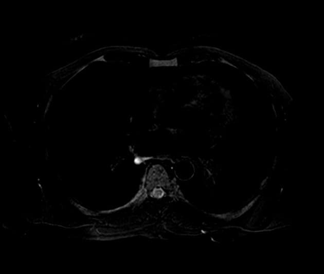 Central Cholangiocarcinoma with Percutaneous Transhepatic Biliary Drainage (PTCD) Placement (Ung thư ống mật trung tâm và đặt ống dẫn lưu qua da dưới hướng dẫn chụp cắt lớp vi tính (PTC))