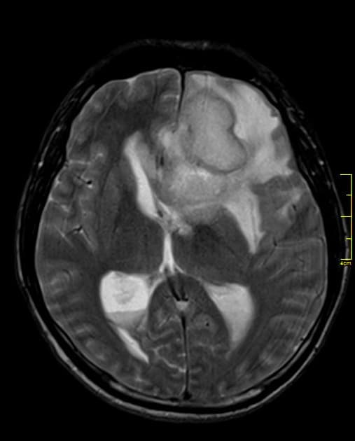 Cerebral Abscess with Ventriculitis (Áp xe não kèm viêm não thất)