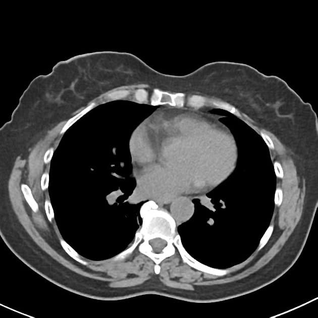 Pancreatic Adenocarcinoma Presenting with Obstructive Jaundice (Ung thư biểu mô tuyến tụy)