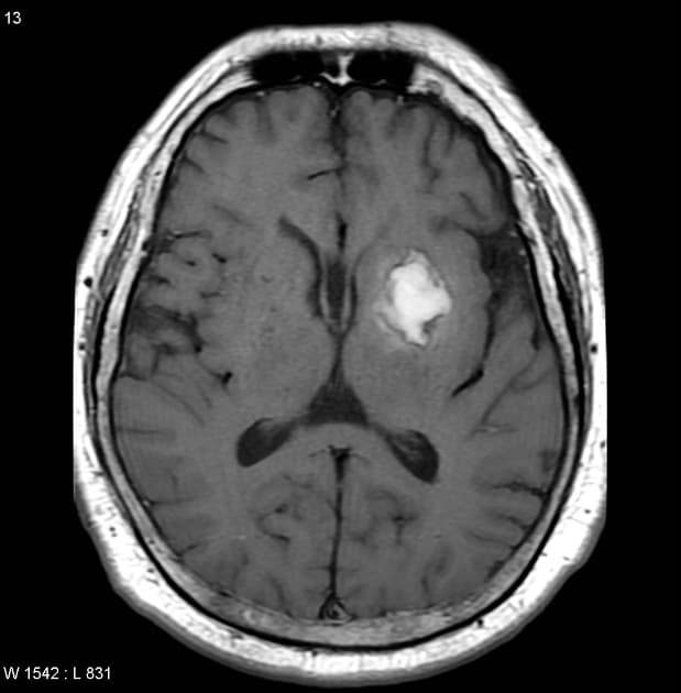 Subacute haemorrhagic stroke - enhancing