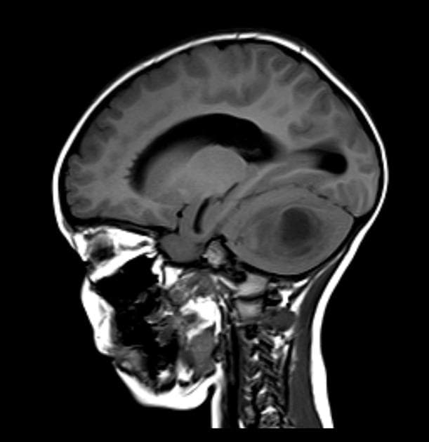 Cerebellar Abscess (Áp xe tiểu não)