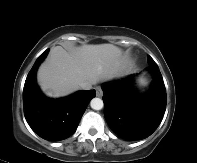 Hepatic adenoma - multiple