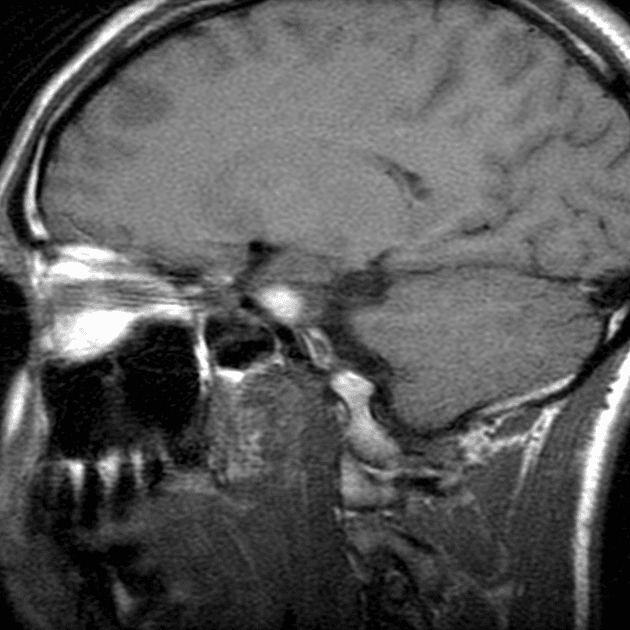 Papillary craniopharyngioma