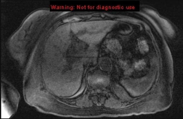 Hilar Cholangiocarcinoma (Klatskin Tumor) (Ung thư ống mật tế bào gan - vùng cửa gan)