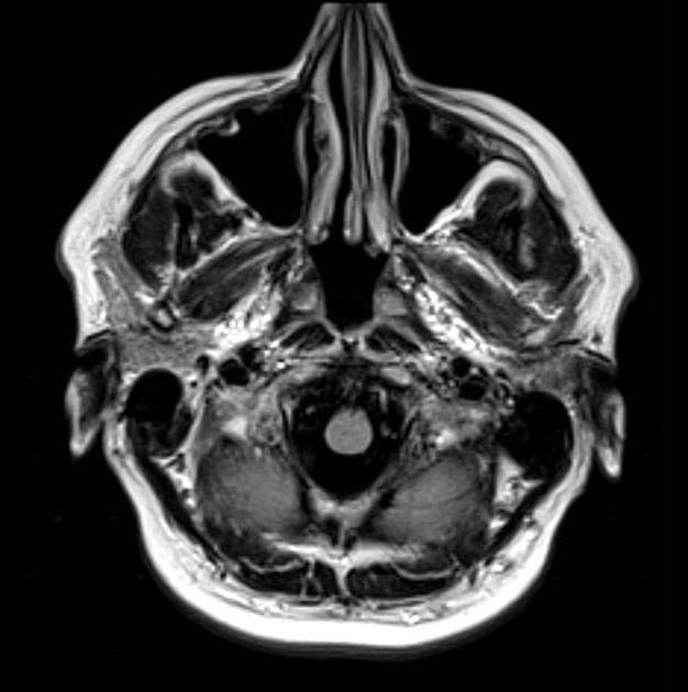 Papillary craniopharyngioma