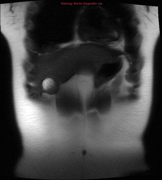 Choledochal Cyst - Type I with Incidental Side Branch Intraductal Papillary Mucinous Neoplasm (U nang ống mật chủ - type I)