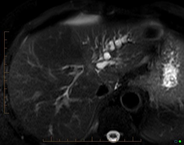 Klatskin Tumor - Hilar Cholangiocarcinoma (U Klatskin - ung thư đường mật cửa gan)
