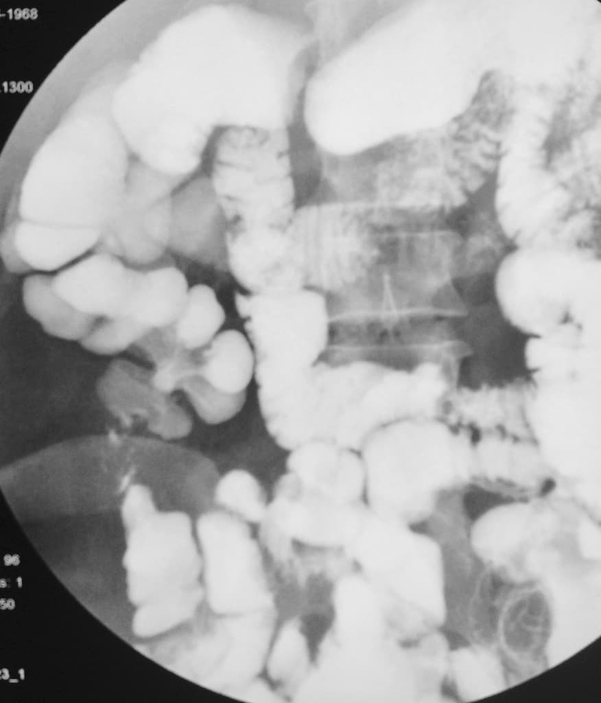 Ileocecal tuberculosis