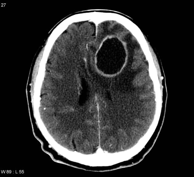 Cerebral Abscess Following Penetrating Trauma (Áp xe não)