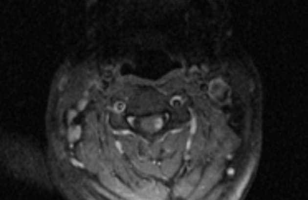 Multiple Sclerosis of the Spine (Xơ cứng rải rác ở tủy sống)