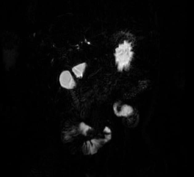 Choledochal Cyst - Type I (MRCP) (Nang ống mật chủ - type I (MRCP))