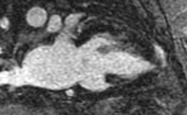 Apical hypertrophic cardiomyopathy