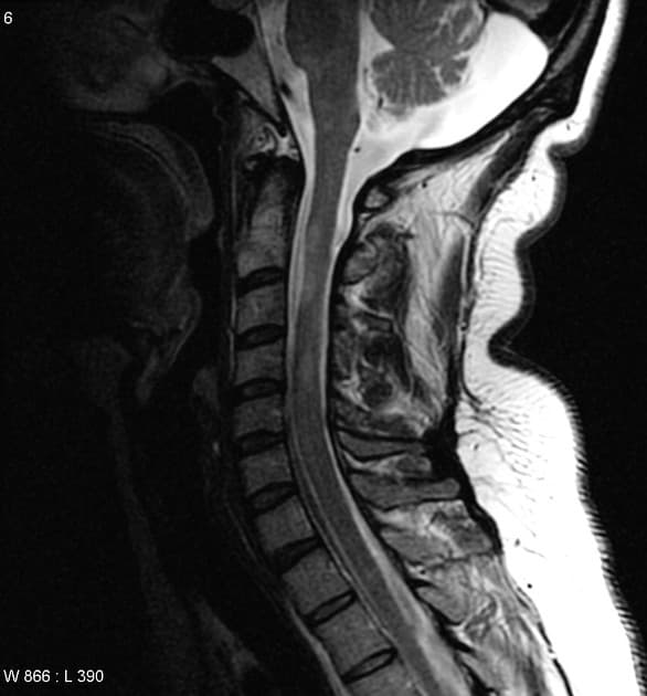 Multiple Sclerosis Involving Brain and Spinal Cord (Xơ cứng rải rác - não và tủy sống)