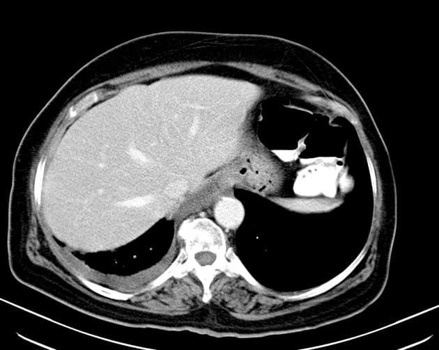 Adenocarcinoma of the Gastric Antrum (Ung thư biểu mô tuyến vùng môn vị dạ dày)