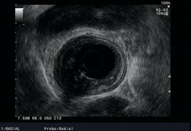 Esophageal Adenocarcinoma (T3N1) (Ung thư biểu mô tuyến thực quản (T3N1))